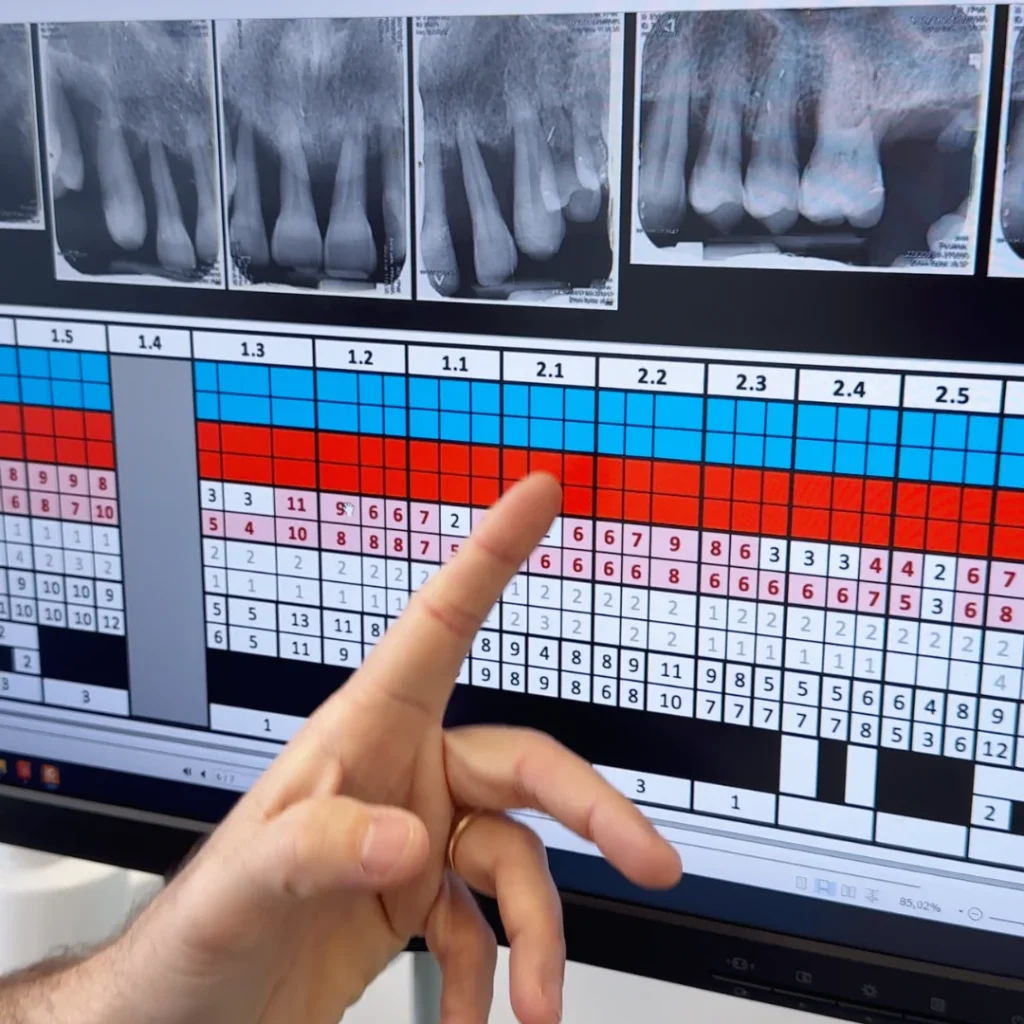 Parodontologia 6 Cura della parodontite a Vicenza