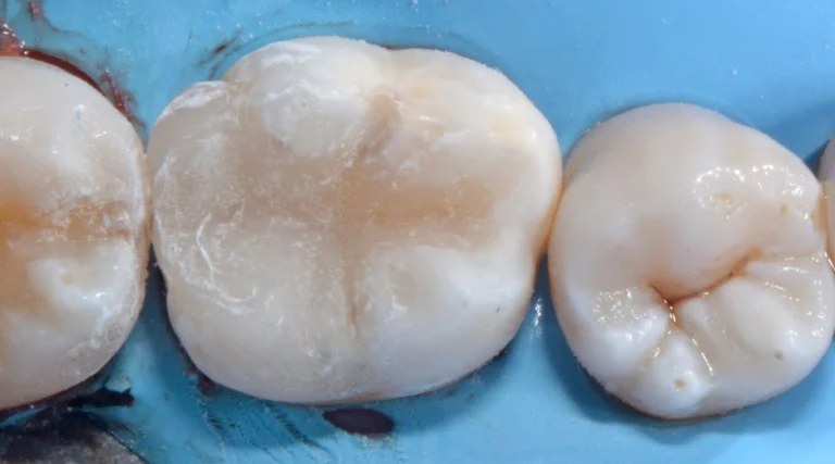 Casi clinici Prima e dopo 14 Rimozione amalgama