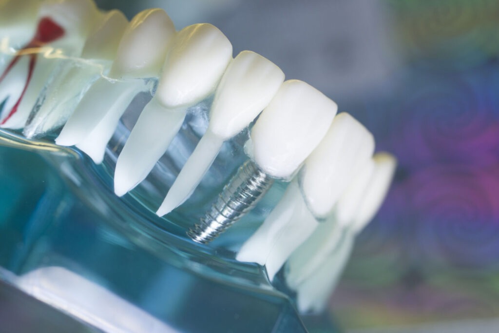 Come riconoscere i sintomi di perimplantite e proteggere la salute degli impianti 2 come riconoscere i sintomi di perimplantite