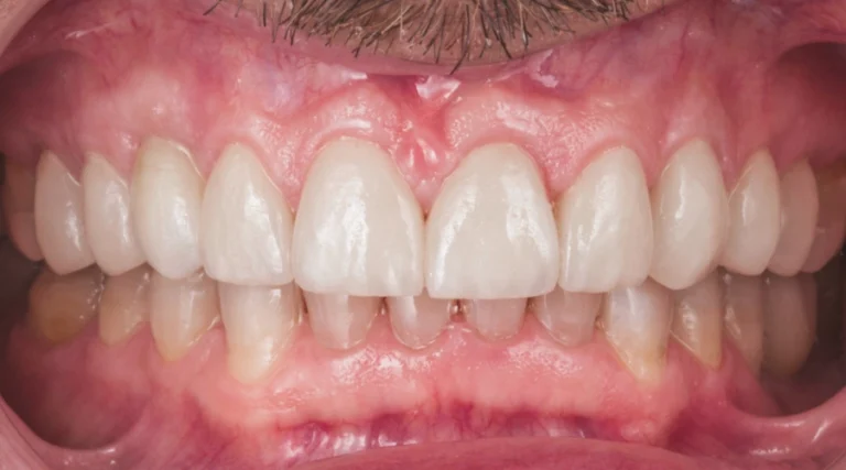 Casi clinici Prima e dopo 2 faccette - dopo