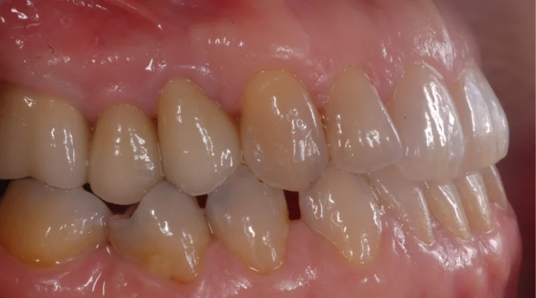 Casi clinici Prima e dopo 4 implantologia - dopo