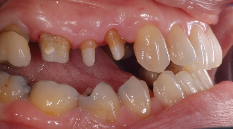 implantologia - prima