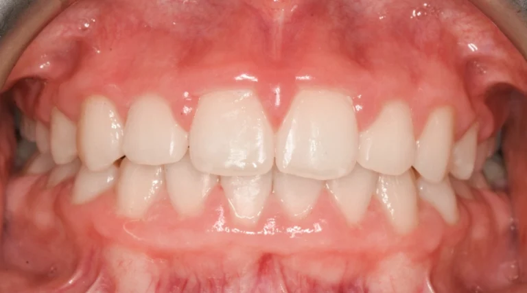 Casi clinici Prima e dopo 8 Ortodonzia