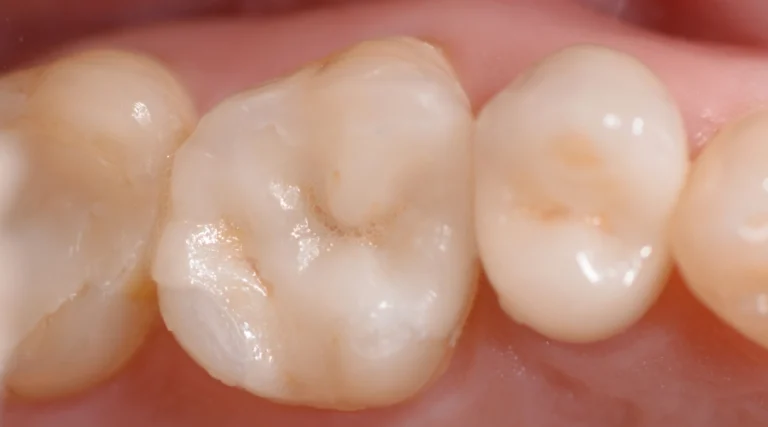 Casi clinici Prima e dopo 10 otturazione