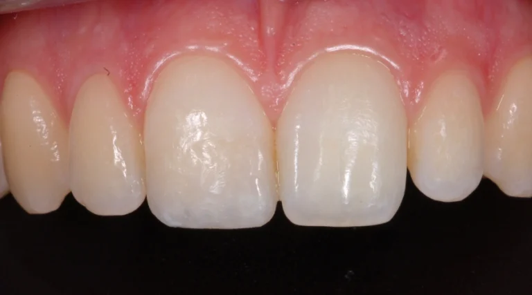 Casi clinici Prima e dopo 12 ricostruzioni estetiche